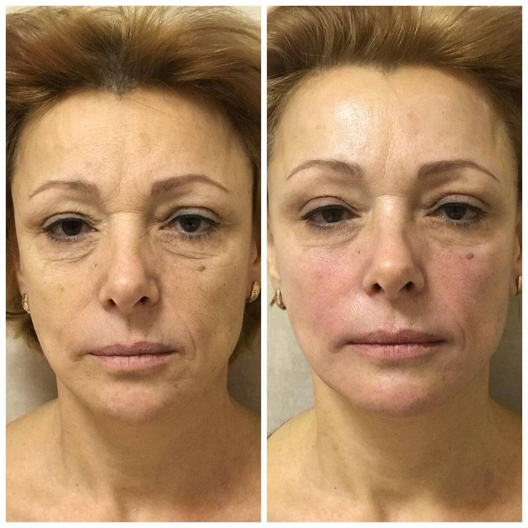 До і після масажу обличчя